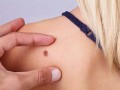 Consigli utili per prevenire il melanoma